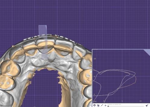 Рисунок 1. Цифровий дизайн усмішки в Exocad перед реставраційним лікуванням. Цифровий дизайн запропонованої реставрації демонструє індивідуалізовану морфологію зубів, анатомічне планування та естетичний аналіз, виконані під час планування лікування.